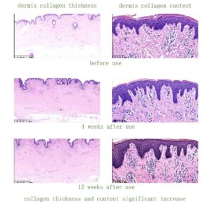 Monopolar RF device,Collagen remodeling therapy,No-downtime skin tightening,Stimulate collagen regeneration,AI-controlled radiofrequency,Full-layer dermal heating technology,Treat nasolabial folds non-surgically